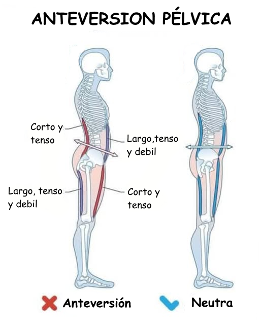 Comparación lateral: pelvis en anteversión frente a pelvis neutra