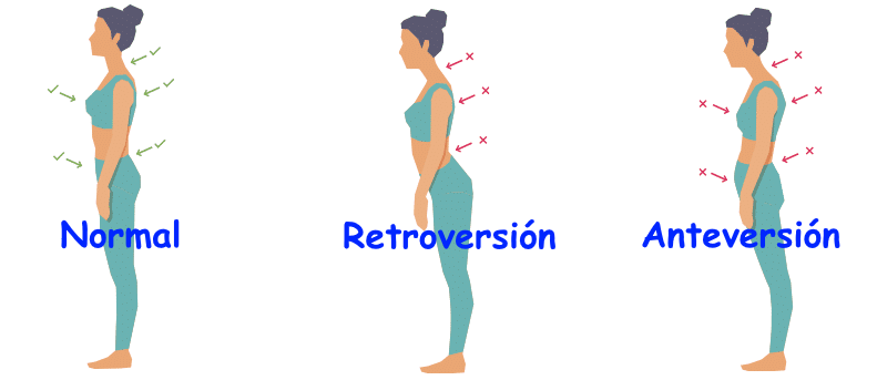 Retroversión pélvica: pelvis inclinada hacia atrás y disminución de la curva lumbar frente a postura neutra