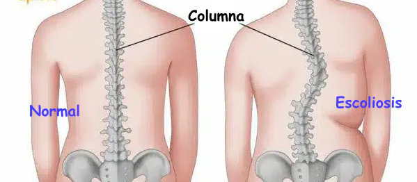 Asimetría postural y escoliosis funcional: diferencias, ejercicio y diagnóstico | ComaBien