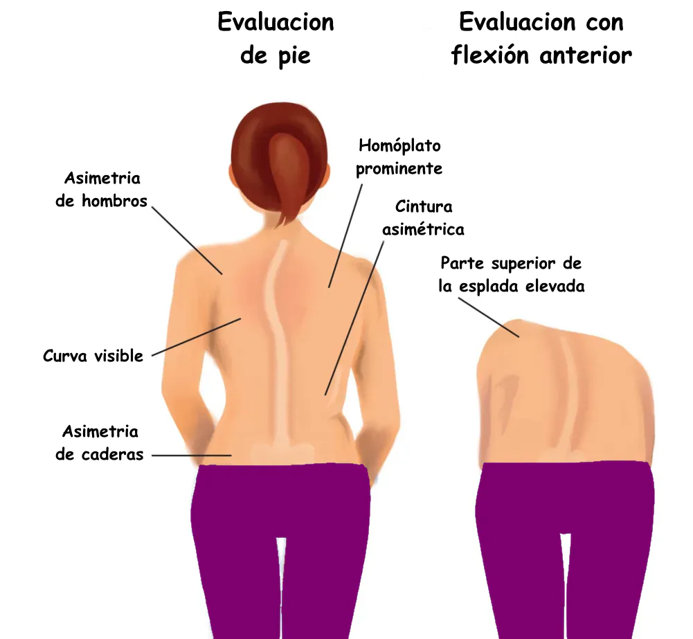 Ejemplo visual de asimetría del tronco