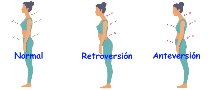 Retroversión pélvica y espalda plana: diferencias, ejercicio y señales de alerta | ComaBien